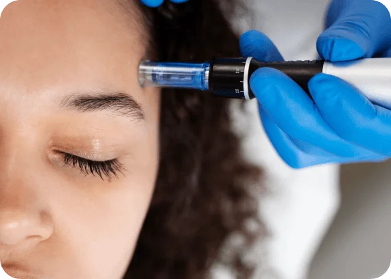 Microneedling Hylauronic acid