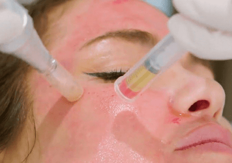 Microneedling Platelet-Rich Plasma (PRP)